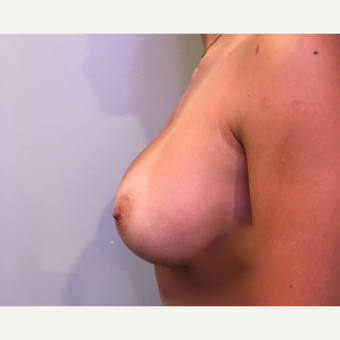 18-24 year old woman treated with Breast Augmentation after 3788728