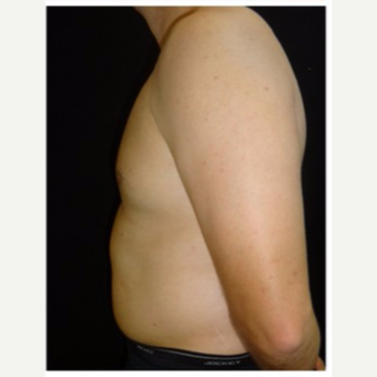 25-34 year old man treated with Male Breast Reduction after 3186022