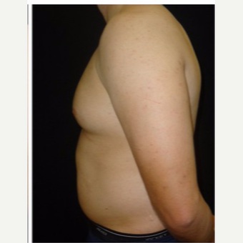 25-34 year old man treated with Male Breast Reduction before 3186022
