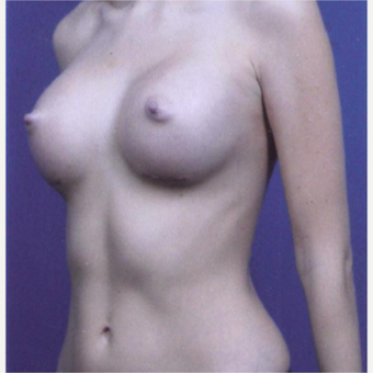 23 year old woman treated with Breast Augmentation - 450 cc high profile silicone gel implants after 3432336