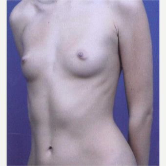 23 year old woman treated with Breast Augmentation - 450 cc high profile silicone gel implants before 3432336