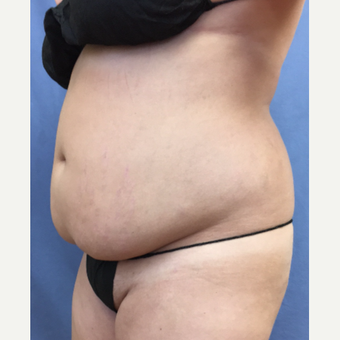 25-34 year old woman treated with Smart Lipo before 3371752