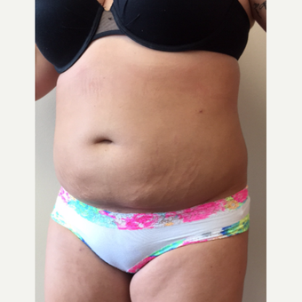 25-34 year old woman treated with Smart Lipo after 3371752