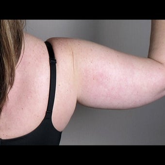 41 Year Old Female Arm Liposuction 1527827