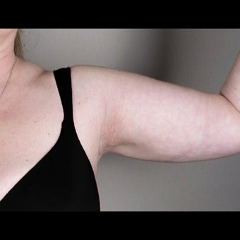 41 Year Old Female Arm Liposuction after 1527827