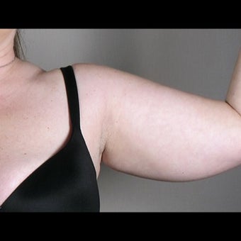 41 Year Old Female Arm Liposuction before 1527827