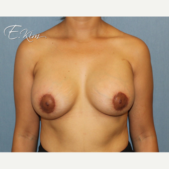25-34 year old woman treated with Breast Lift with Implants after 3663460
