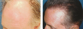 45-54 year old man treated with Hair Transplant before 3502884