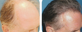 45-54 year old man treated with Hair Transplant after 3502884