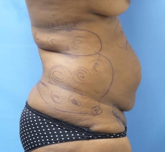 35-44 year old woman treated with Tummy Tuck before 3168380