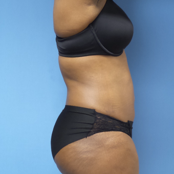35-44 year old woman treated with Tummy Tuck after 3168380