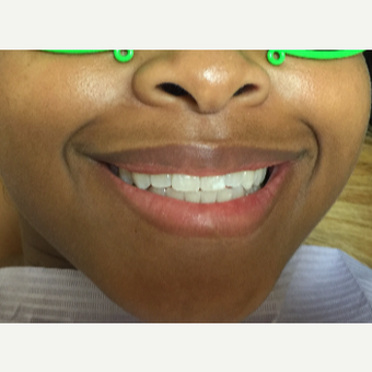 18-24 year old model treated with ten Porcelain Veneers before 3165515