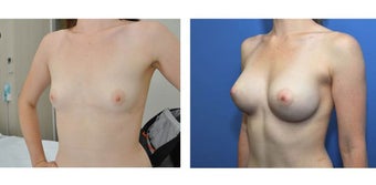 24yo, no children. 360g anatomic (teardrop) moderate profile implants, subpectoral position, A–> D cup after 1210460