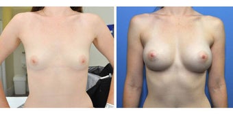 24yo, no children. 360g anatomic (teardrop) moderate profile implants, subpectoral position, A–> D cup before 1210460