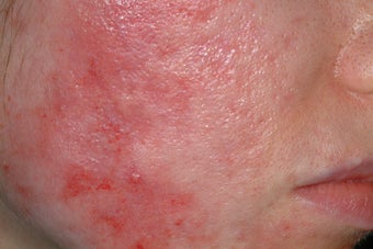 Acne scar treatment before 92028