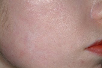Acne scar treatment after 92028