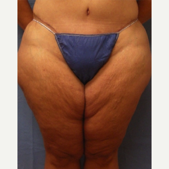 45-54 year old woman treated with Liposuction before 3589013