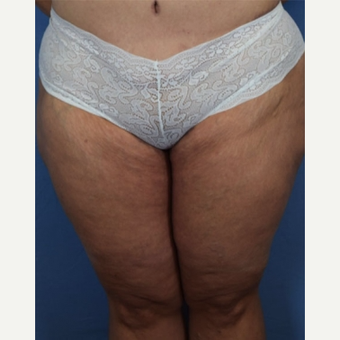 45-54 year old woman treated with Liposuction after 3589013