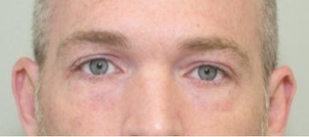 35-44 year old man treated with revisional eyelid surgery before 2616033
