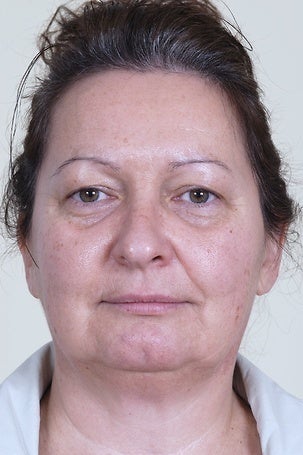 Injectable Fillers before 1076894
