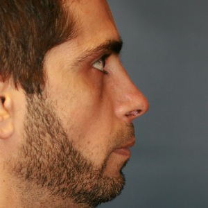 35-44 year old man treated with Revision Rhinoplasty before 3559741