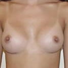 35-44 year old woman treated with Breast Augmentation after 3743609
