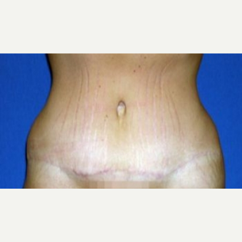 25-34 year old woman treated with Tummy Tuck after 3009847