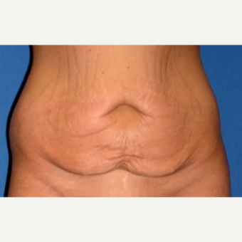 25-34 year old woman treated with Tummy Tuck before 3009847