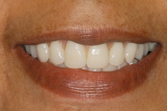 Replacement of hopeless teeth with implant supported bridge. after 1041908