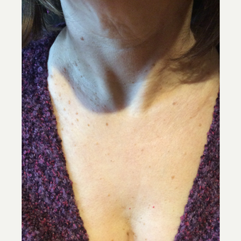 55-64 year old woman treated with Ultherapy after 3459912