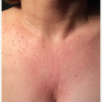 55-64 year old woman treated with Ultherapy before 3459912