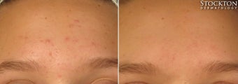18-24 year old woman treated with LED Skin Treatment before 2103343