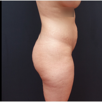 25-34 year old woman treated with Butt Augmentation before 3267018