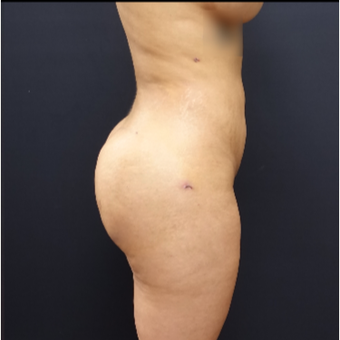25-34 year old woman treated with Butt Augmentation after 3267018