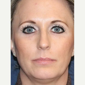 Artefill | Bellafill for Under Eye Tear Trough and Lip Wrinkle Treatment after 1663755