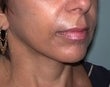 48 year old female patient 923007