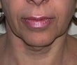 48 year old female patient before 923007