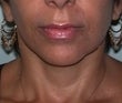 48 year old female patient after 923007