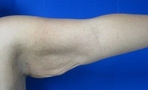 Arm Lift before 3094432