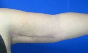 Arm Lift after 3094432