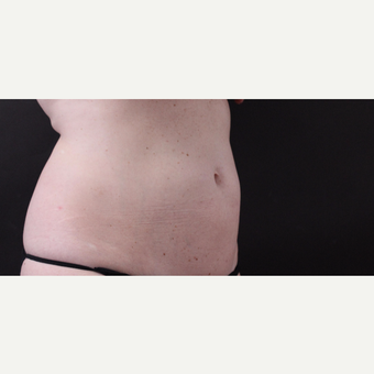 46 year old woman treated with CoolSculpting after 3168914