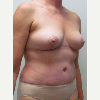 Mommy Makeover for this 55 Year Old Woman after 3791744