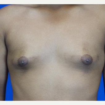 18-24 year old man treated with Male Breast Reduction before 3542881