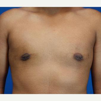 18-24 year old man treated with Male Breast Reduction after 3542881