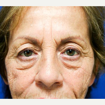 65-74 year old woman treated with Eyelid Surgery before 3093910