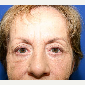 65-74 year old woman treated with Eyelid Surgery after 3093910