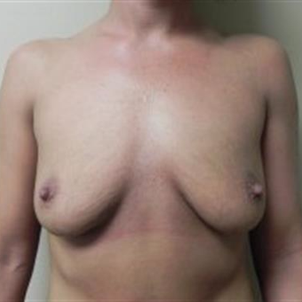 25-34 year old woman treated with Breast Augmentation before 3378450