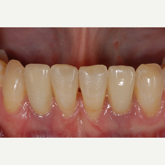 35-44 year old woman treated with Dental Implants. after 3560255