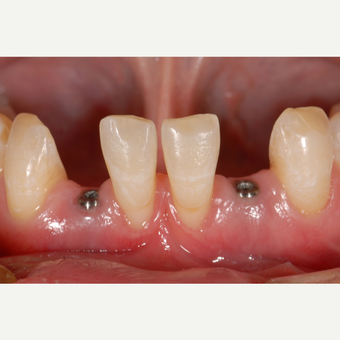 35-44 year old woman treated with Dental Implants. before 3560255