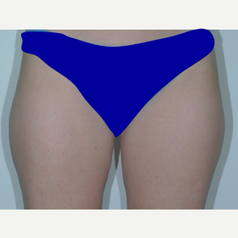 Liposuction before 3346069